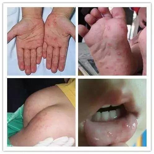 警惕!手足口病进入高发期,家有小孩的要看看
