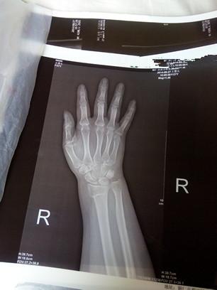 李医生好,情况是这样子的,我朋友前几天出了场小车祸,右手手腕骨折