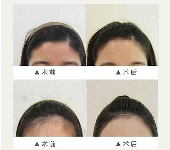 激光脱毛|西安脱发际线 告别杂乱碎发 全城特惠 限时特价不等待_悦美