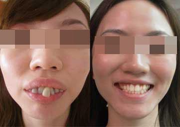 (龅牙矫正前后对比图)