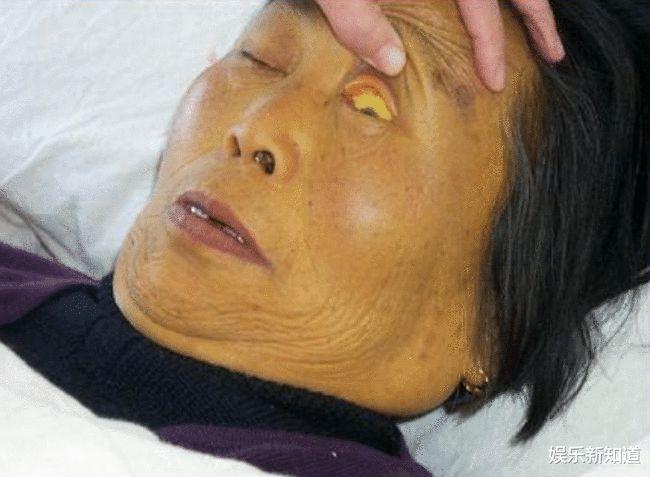 的则是面部暗淡发黄,在眼下表现为黑眼圈,这都是典型肝病面容的表现