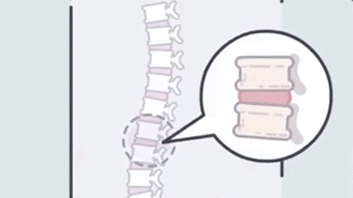 于是, "腰椎间盘突出"早早地找上了你