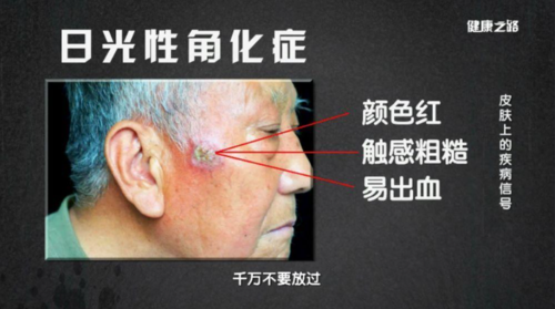 日光性角化病也叫做光线性角化病或老年性角化病.