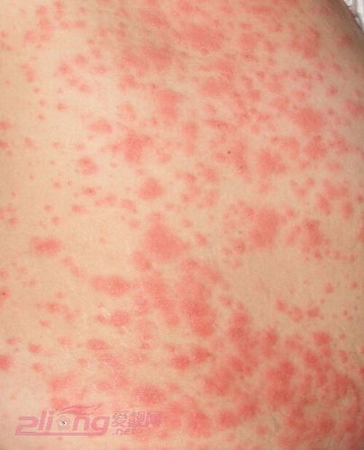 皮肤过敏症状图片及缓解症状办法