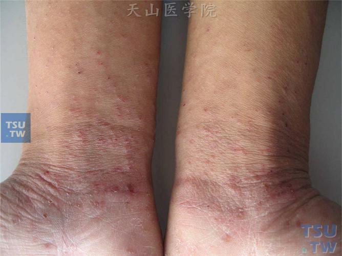 疥疮(scabies)的症状表现