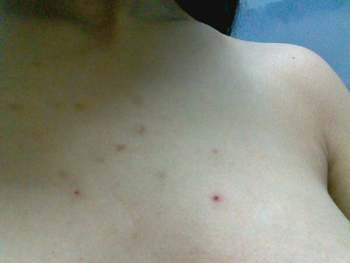 孩子胸口背上出现泡泡(痘痘?)怎么办