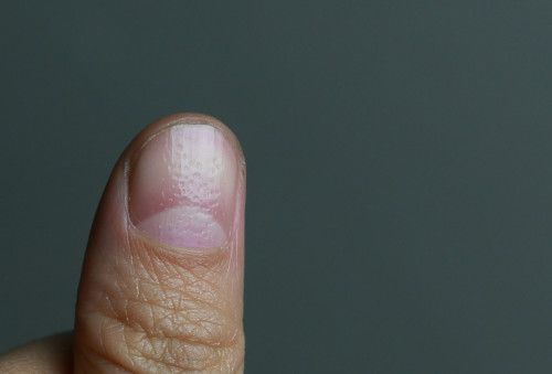 指甲上坑坑洼洼.之前一点现在越来越多.怎么回事.求