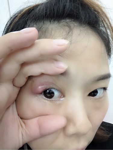 怀孕19周,眼睛长了麦粒肿,又痛又肿,医生说长出包就要切 马上婚期五天