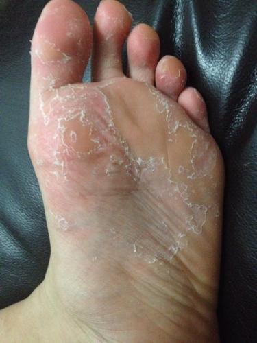 2013-11-02 孟宪伟 医师 脚老是蜕皮,好痒怎么办,怀疑是脚气,该用什么