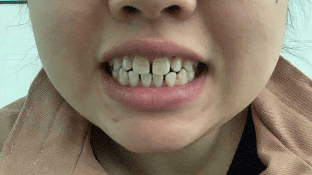 斑釉症又称氟斑牙黄斑牙多发生在恒牙乳牙很少见