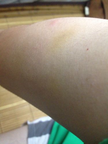 右手臂上有5块浅黄色(要仔细看才看的清楚是黄色)按下去有点小痛,不按