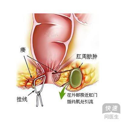 肛瘘患者吃什么才健康