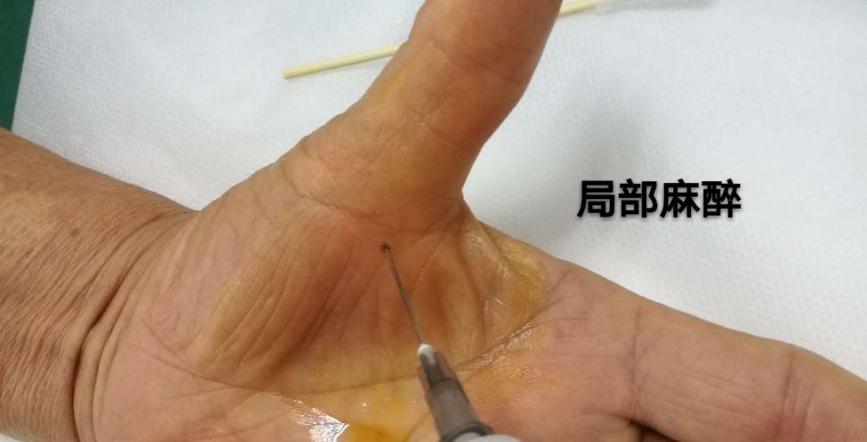 小针刀治疗屈指肌狭窄性腱鞘炎(扳机指)