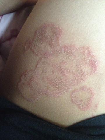 肚子和大腿内侧都有这种情况,一个一个圆形的有很多