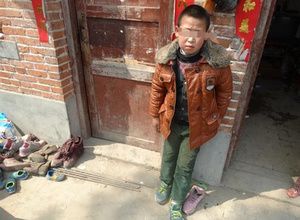 脑炎后遗症有什么典型症状