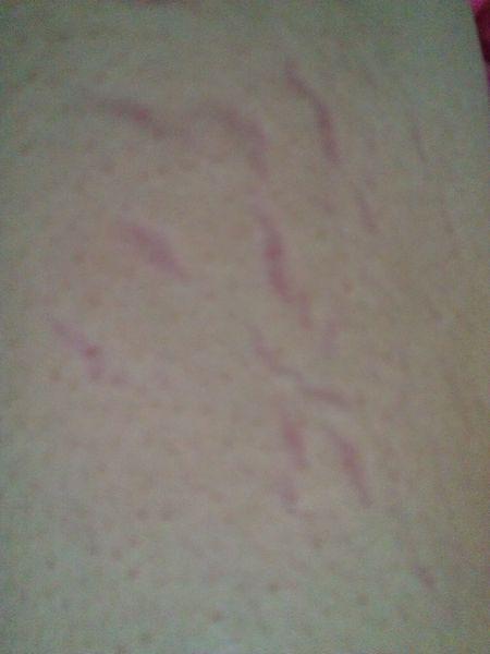 今天发现了右腿膝盖向上一点的腿内侧也出现了 请问这是什么东西