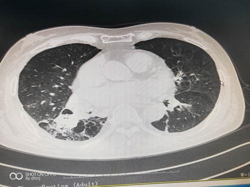 支气管扩张,自发性气胸,肺复张术后,痰液潴留,经支气管镜吸痰处理后