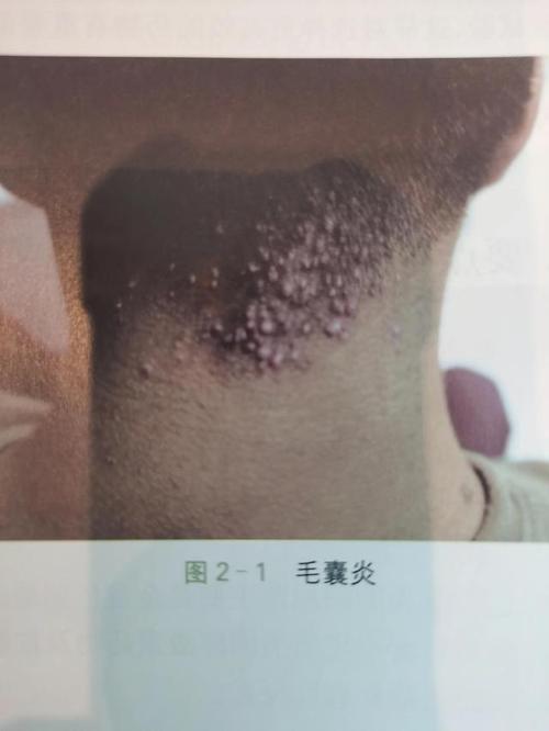 毛囊炎怎么治疗毛囊炎多久能痊愈