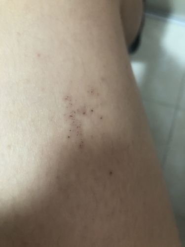 如图,前两天熬夜然后就长了这个会破皮会结痂洗澡有点点疼……是什么