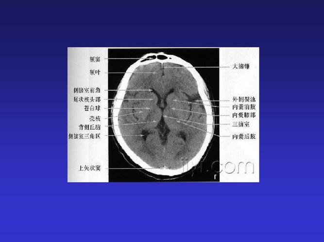 正常头颅ctppt