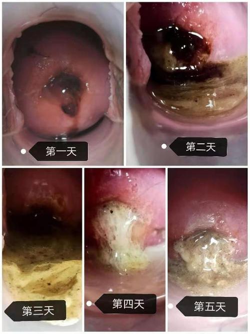 患者治疗过程排出大量子宫垃圾