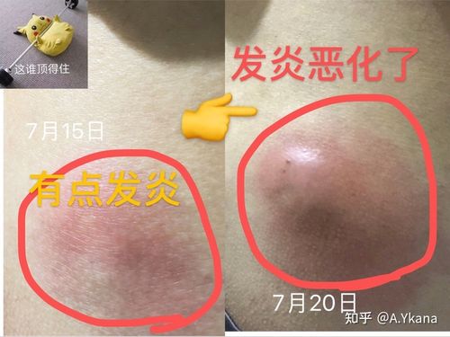 皮脂腺囊肿发炎惨痛经历