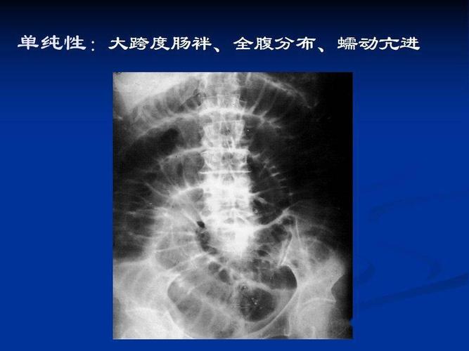(高清图片 文字讲解)肠梗阻的分类及影像学表现_平台