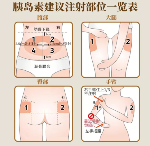 胰岛素注射技术全攻略