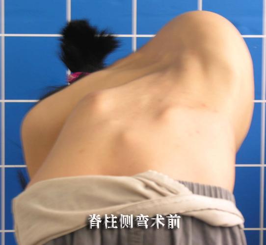 脊柱侧弯手术案例展示七十五