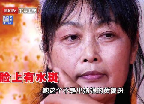 脸上长这种斑,是身体内"水多了",伤心又毁肾!