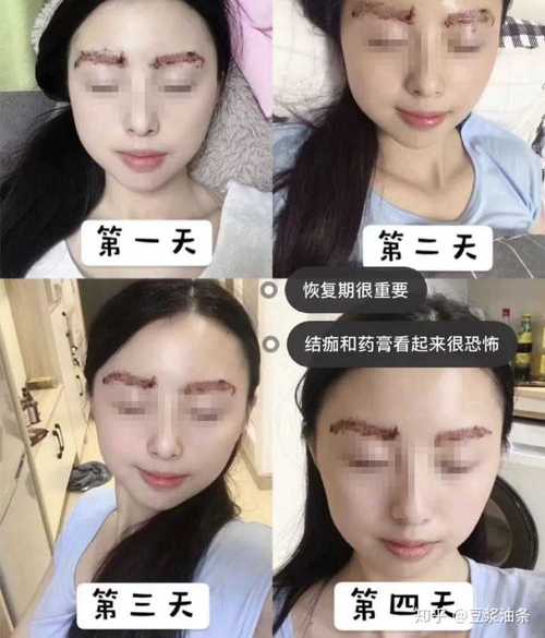(2)皮秒洗眉