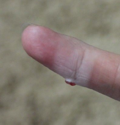 手指上长了肉芽,迟迟无法愈合,弄破流血不止,止血后一直出水 该怎么