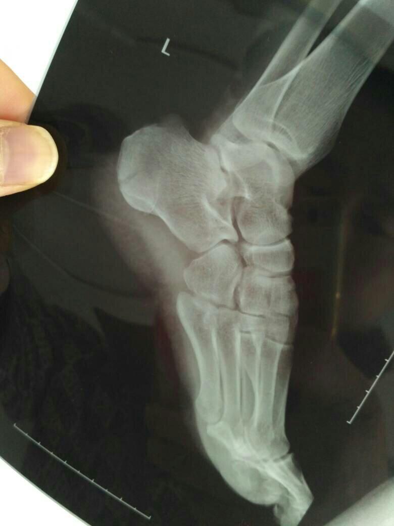 脚跟骨轻微骨裂