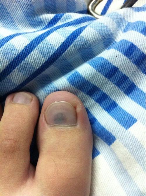 我想问一下,这是不是灰指甲?昨天刚发现的