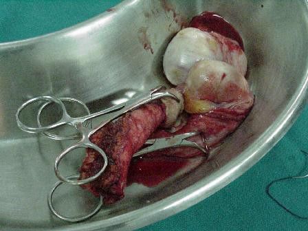 【转载】变性手术(男变女,血腥慎入)