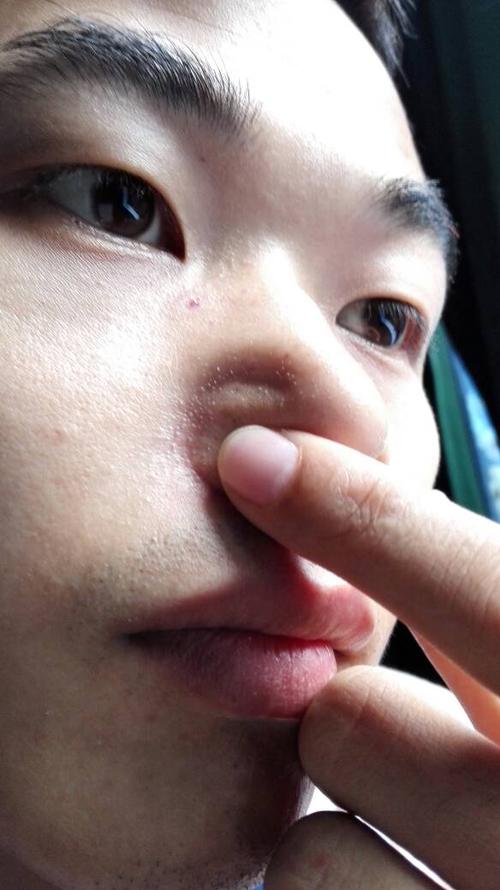 我鼻子上这些是什么呀?一颗颗的白色粉刺或酒刺,长了很久了,怎么治疗?