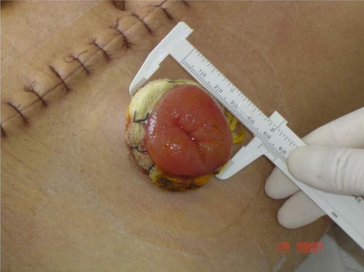 直肠癌冷冻保肛可行吗?直肠癌患者做直肠支架的利弊分析