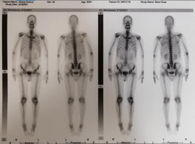 全身骨显像检查
