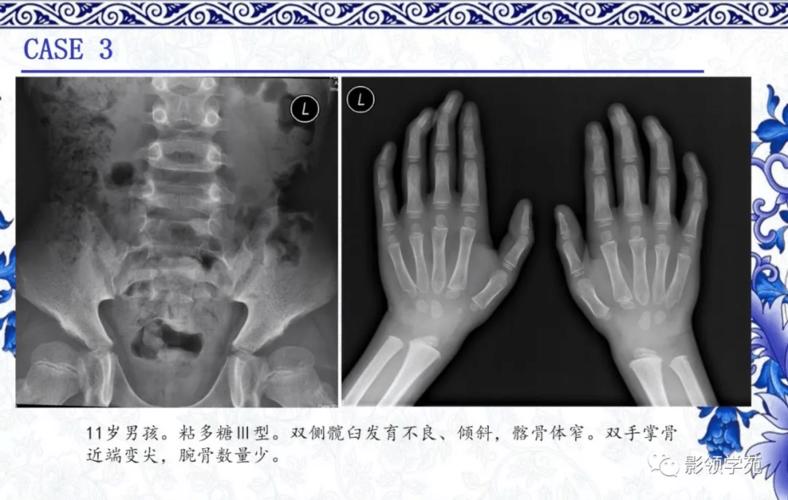 7种常见的骨软骨发育异常x线表现
