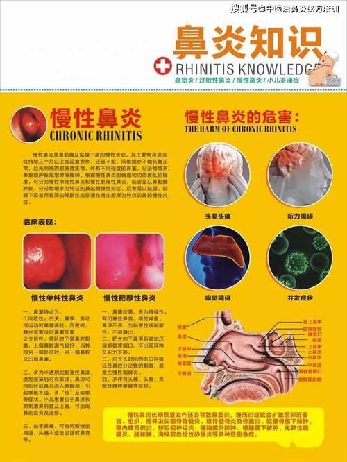 慢性鼻炎的症状