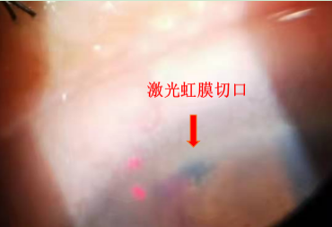 激光周边虹膜切除术