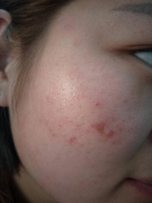 昨天挤粉刺挤破了一层皮,今天就这样了,该怎么修复,还有毛孔粗大痘印