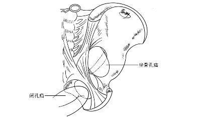 网易首页>网易号>正文申请入驻> 闭孔疝位于耻骨肌的深层,股三角区的