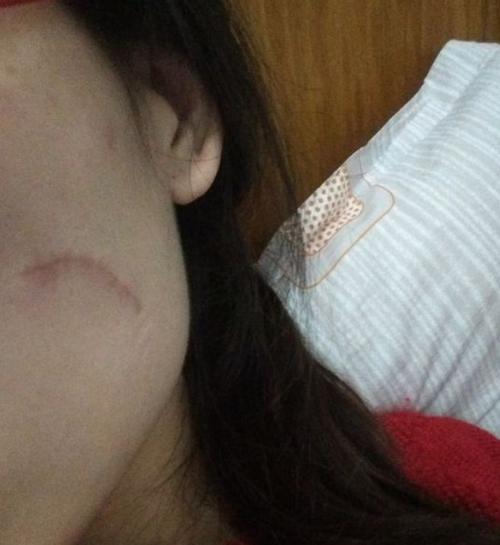 给大家看看我的脸上的手术切除祛疤过程图片