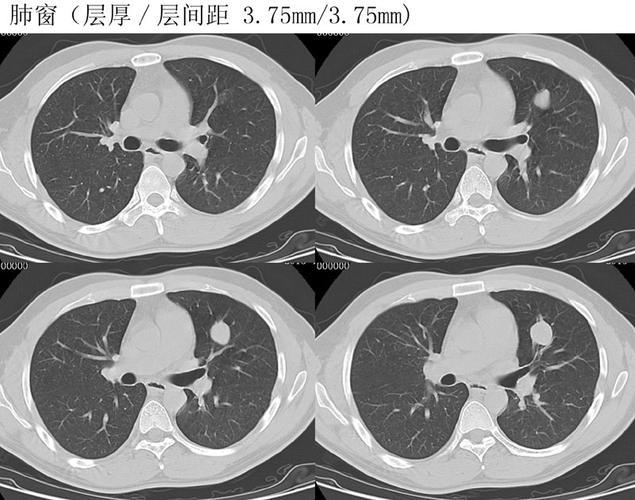 x13664左肺上叶占位病灶