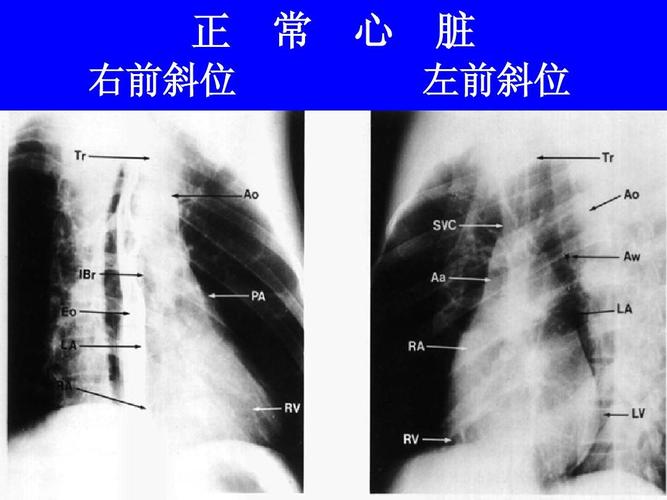 正 右前斜位 常 心 脏 左前斜位