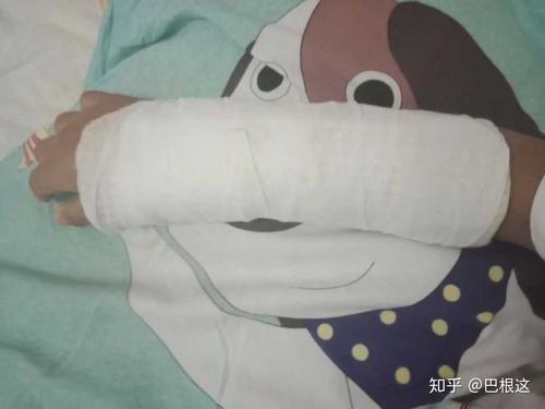 手上打石膏如何洗澡