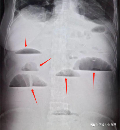 小肠梗阻 特点:气液平面.