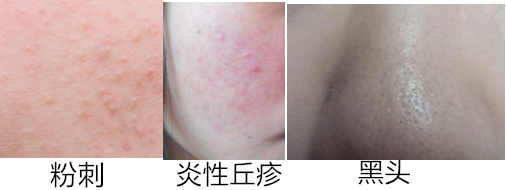 粉刺,黑头,炎性丘疹