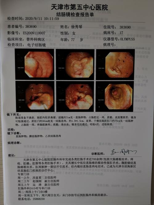 一例横结肠癌同时直肠癌病例汇报